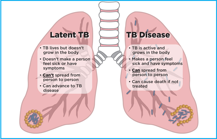 Hiv And Tuberculosis Tb Nih